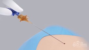 Catheter Introduction Without Scapel | 3D Animation Video | 3Dforscience