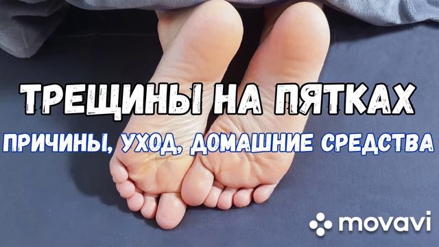 КАК СПРАВИТЬСЯ С  ТРЕЩИНАМИ НА ПЯТКАХ. Причины, уход, домашние средства.