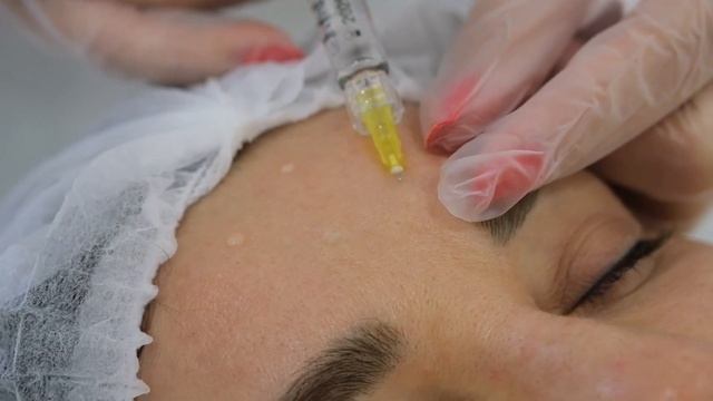 Биоревитализация — это процедура введения препаратов на основе гиалуроновой кислоты в кожу. смотреть онлайн