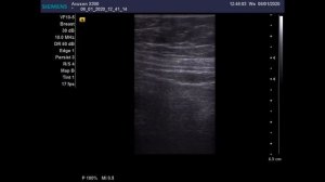 Дивертикулит сигмовидной кишки