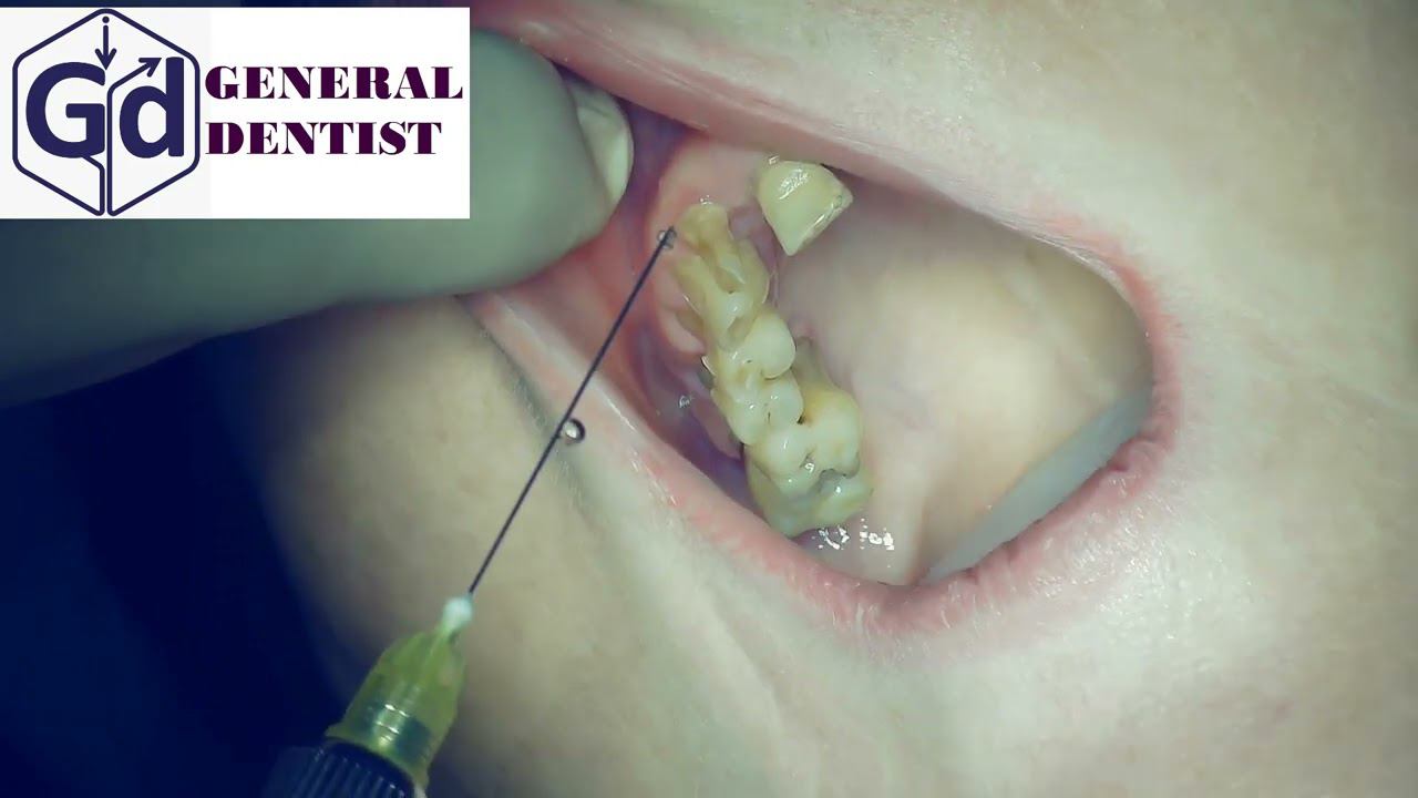 Infiltration anesthesia for extraction 12 tooth.