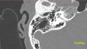 КТ-анатомия височной кости