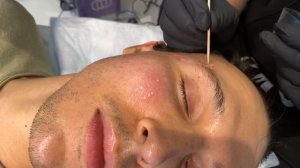 HOW TO GET RID OF ICE-PICK ACNE SCARS | TCA Cross to Face for Deep Acne Craters | Dr. Jason Emer