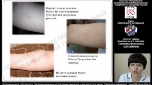 Современная иммунодиагностика туберкулёза. Кожные пробы с туберкулином и рекомбинантными антигенами