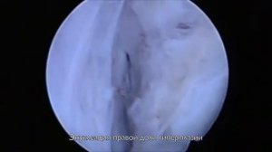 Лазерная энуклеация аденомы простаты больших размеров