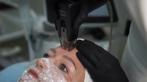 РФ-лифтинг лица Morpheus 8