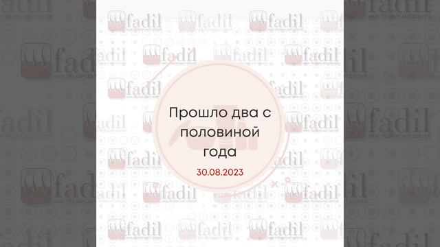 Пересадка волос 2500 графт методом FUE. Результат спустя 2,5 года