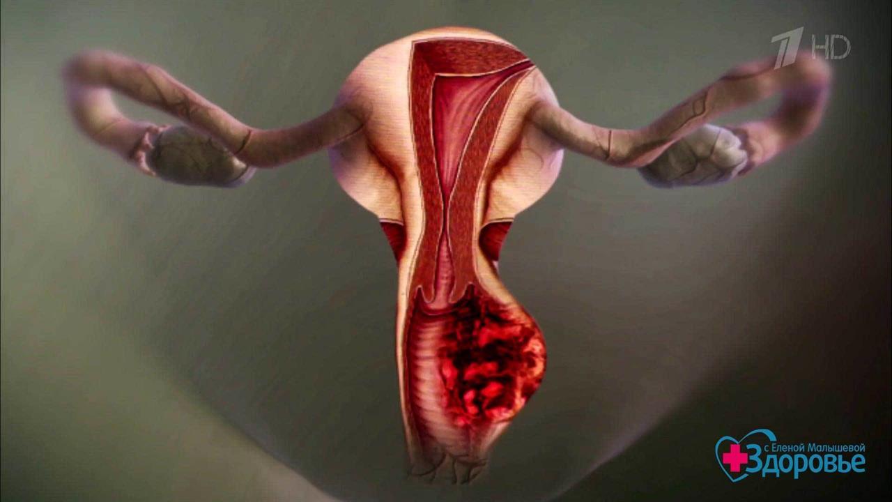 рак матки из за спермы фото 100