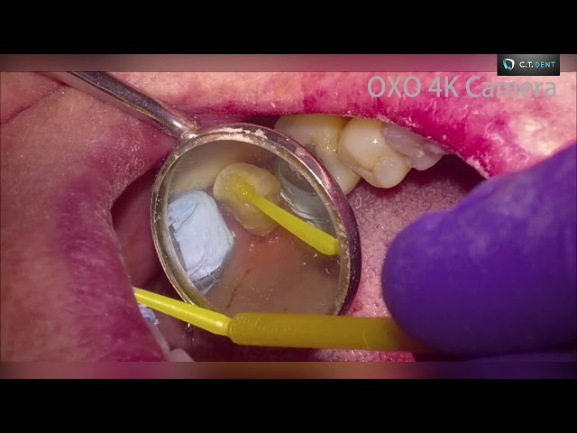 Стоматологическая камера 4K OXO