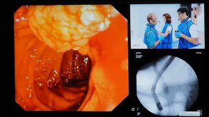 03Live Juan Dot Bach EMR Adenoma of Duodenal Papilla