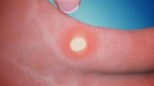 Афтофикс - при язвочках во рту. Качество из Швейцарии.