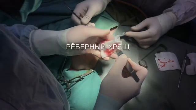 Secondary Rhinoplasty смотреть онлайн