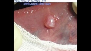 Киста яичника народные рецепты