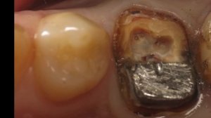Cast Post Removal / Извлечение культевой вкладки
