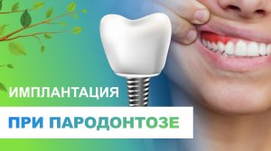 ✔️ Имплантация зубов при пародонтозе