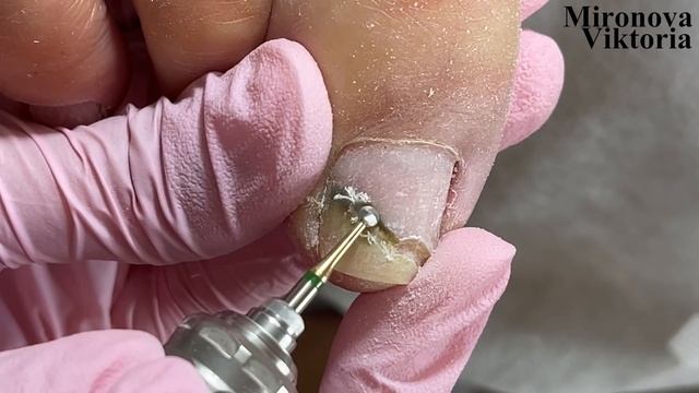 Неприятный сюрприз под гель лаком?! Частичный педикюр