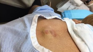 Infected Cyst on Mid-back