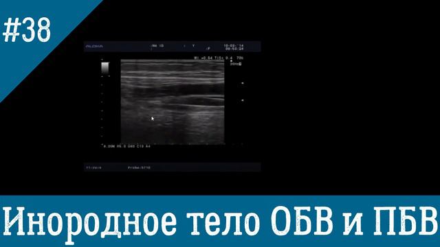 УЗИ вен. Инородное тело в глубокой вене на уровне бедра.