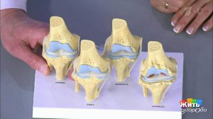 Лечусь по интернету. Боль в колене. Жить здорово! Фрагмент выпуска от 26.05.2020