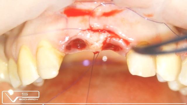 Восстановление сосочка по Сузуки Массано смотреть онлайн
