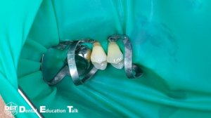 Изоляция пришеечной области 14, 15 клампы B4, кариес класс-V DET.expert & Sanctuary 4K