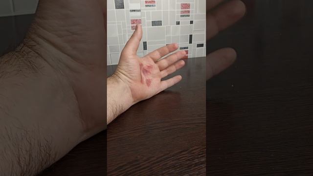 Что делать при ожоге медузой. Последствия смотреть онлайн