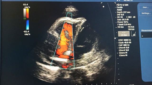 Вегетация или опухоль смотреть онлайн