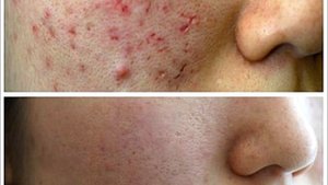 ЛАЗЕРНАЯ ШЛИФОВКА ЛИЦА