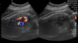 Исследование кровотока в аорте. Беременность 20 недель.
