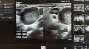 Реактивная воспалительная лимфаденопатия на УЗИ. Reactive inflammatory lymphadenopathy on ultrasoun