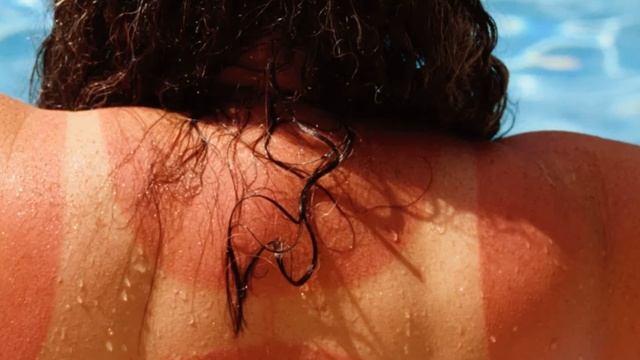 Сгорел на солнце что делать смотреть онлайн