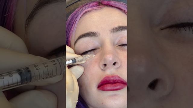 Los Angeles Under Eye & Cheek Filler Injections by Dr. Rivkin | Santa Monica Facial Fillers