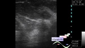 УЗИ молочных желез - Образование по типу звезды