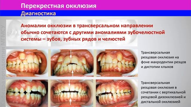 5.4 Аномалии окклюзии по трансверсали