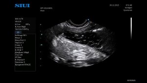 УЗИ желудка норма