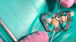 ТЕРАПЕВТИЧЕСКИЙ ВИНИР