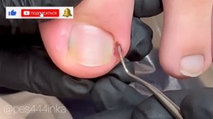Вросший ноготь у ребенка/ воспаление на пальце/ прием у подолога