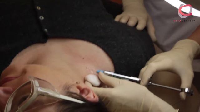 Удалить родинку | в Таллинне, Витаклиника — Часть 1 смотреть онлайн