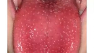 Болезни, о которых может рассказать наш язык  Бегу за зеркалом!