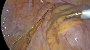 Лапароскопическая передняя резекция прямой кишки + ISG.