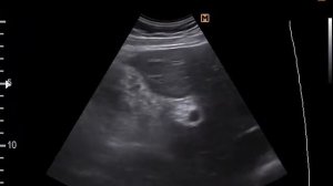 Холестероз желчного пузыря (24-5-17)