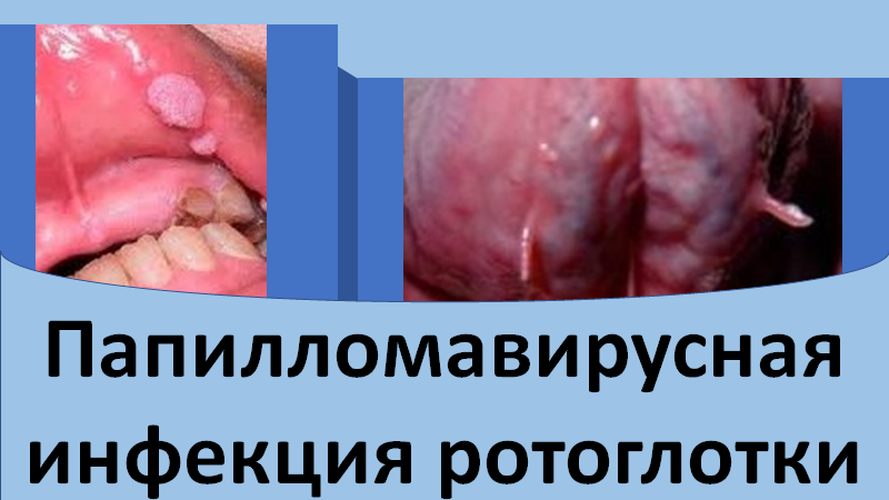 Папилломавирусная инфекция ротоглотки
