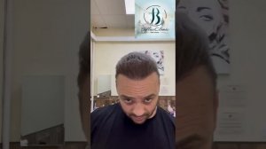 Отзыв Александра через 6 месяцев после пересадки волос