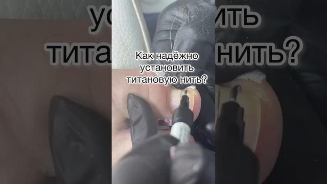 Как надежно установить титановую нить?⠀