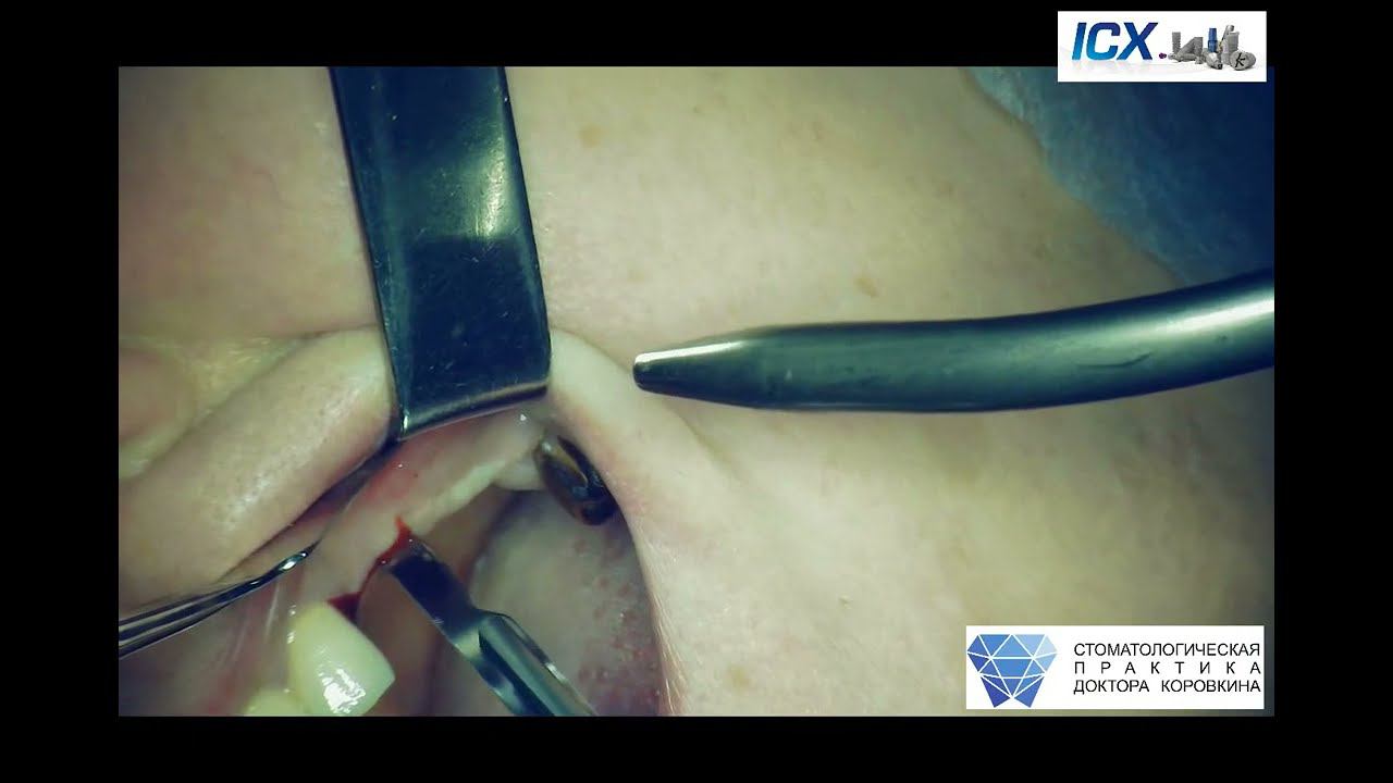 Insertion 3 ICX- Premium in maxilla after sinus lifting area 16,26.After augmentation in area  23.