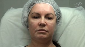 Собираем шприц с канюлей. Контурная пластика канюлей и филлерами Princess/ "Корнеаль"