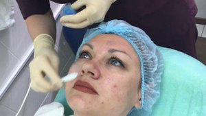 ПИЛИНГ ЛИЦА. Поверхностный пилинг. ДО и ПОСЛЕ. SPF 50 защита.КАК ВЫБРАТЬ?