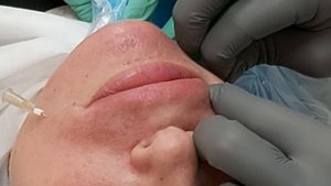 АирисКом студенты учатся: урок по мезонитям. Носогубная складка.