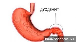 Дуоденит. Как лечить дуоденит.