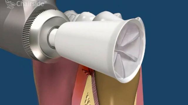 удаление зубного камня смотреть онлайн